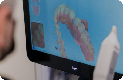 Escaneamento intraoral com iTero