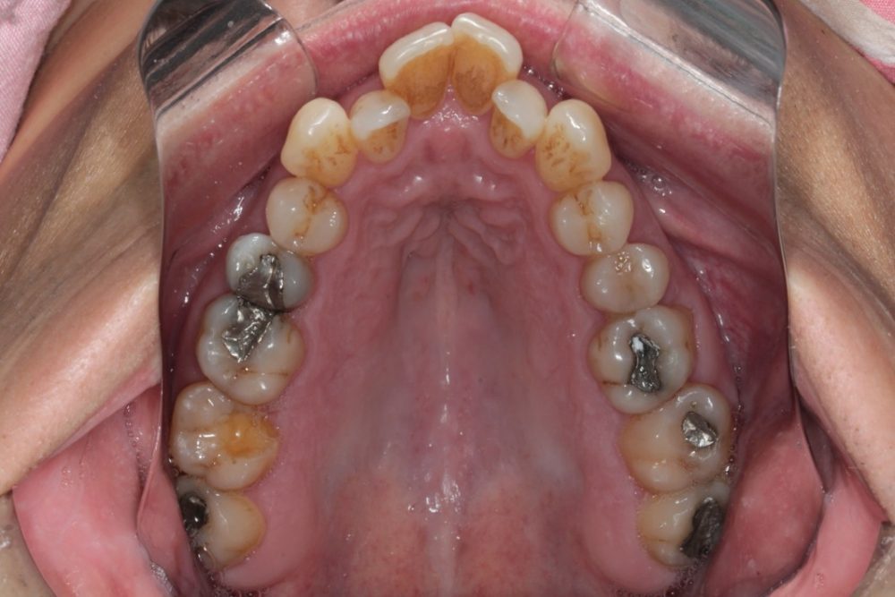 Foto da boca depois do tratamento