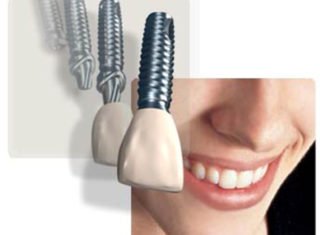 Implantes Dentários