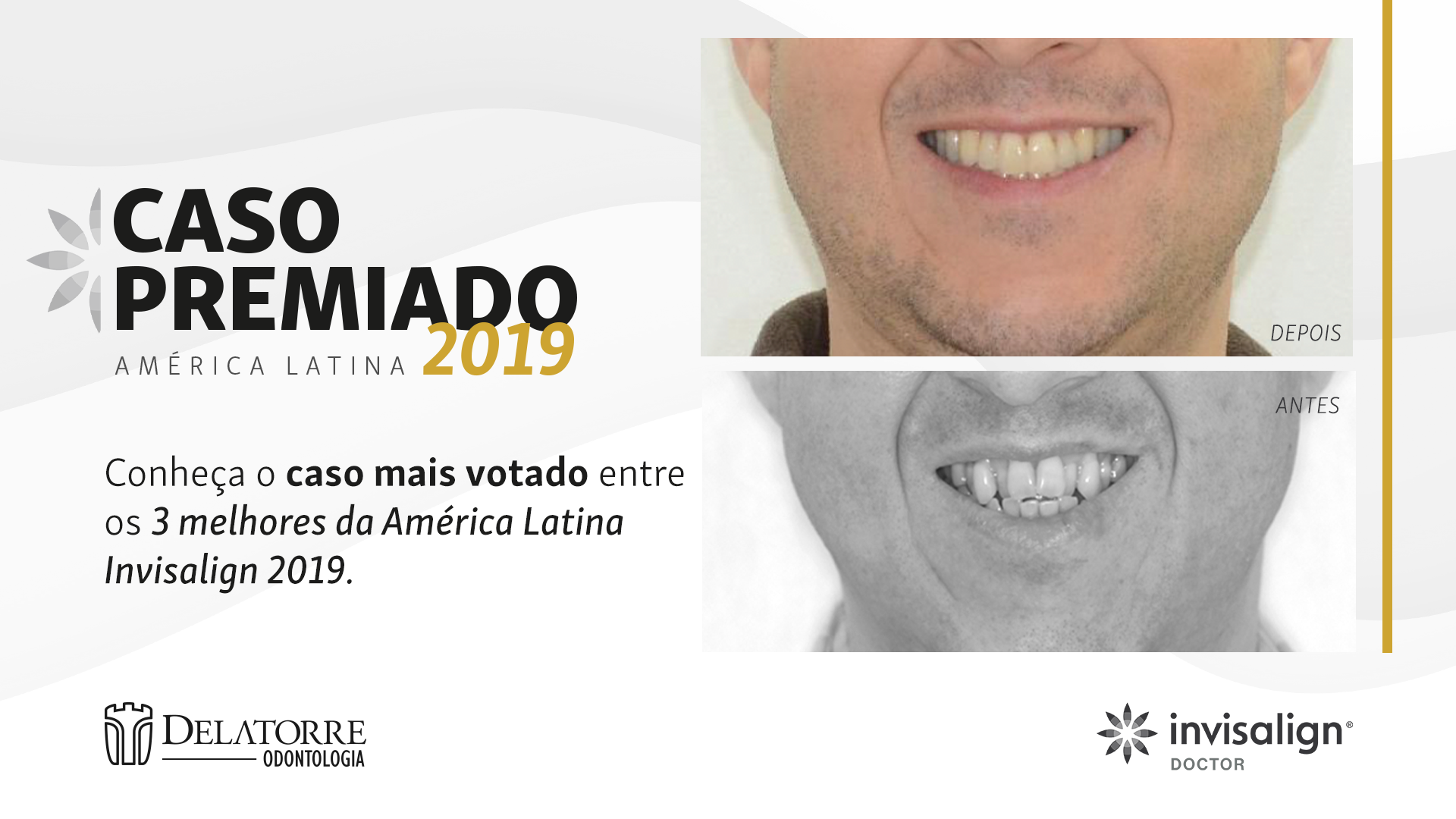 Invisalign Curitiba: Alinhador Transparente