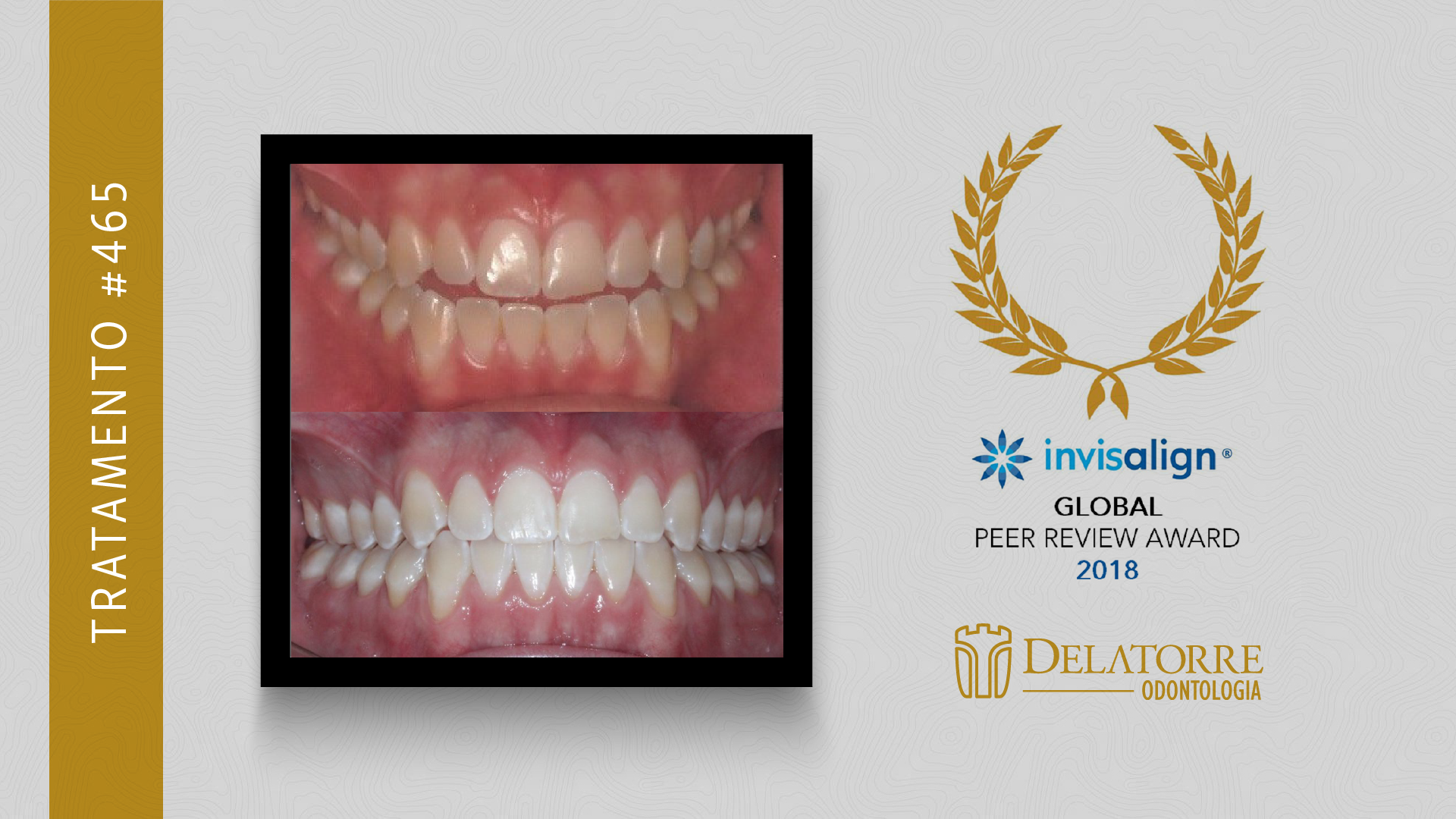 Invisalign Curitiba: Alinhador Transparente