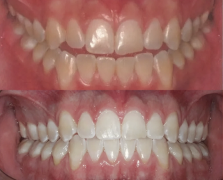 Imagem de antes de depois paciente Guilherme