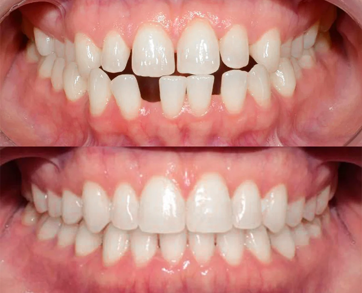 Classe III com Invisalign