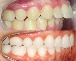 Imagem de antes e depois Adulto
