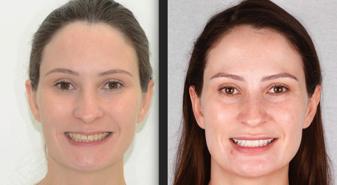 Meu antes e depois com o Invisalign (9 meses depois) - Monalisa de Batom